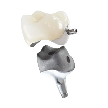 PFM Non Precious Cement Retained Crown