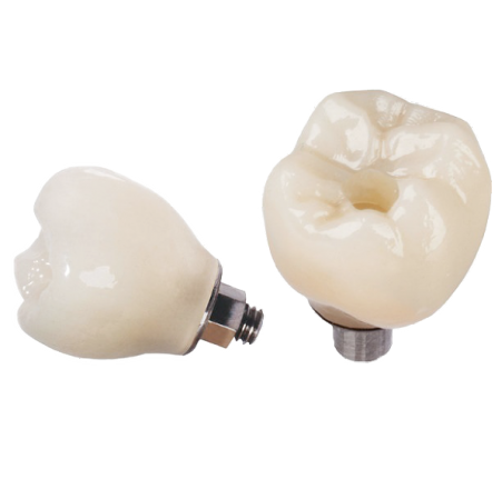 Porcelain to Zirconia (PFZ) Screw Retained Crown