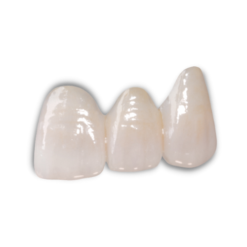 e.Max Crowns, Inlays, and Onlays