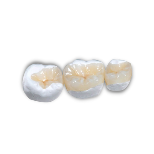 e.Max Crowns, Inlays, and Onlays