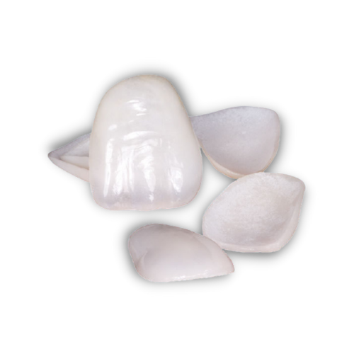 e.Max Veneer
