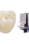 Full Strength Zirconia Cement Retained Crown