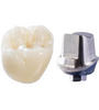Full Strength Zirconia Cement Retained Crown