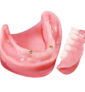 Locator Overdentures