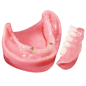 Locator Overdentures