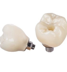 Porcelain to Zirconia (PFZ) Screw Retained Crown