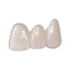 e.Max Crowns, Inlays, and Onlays