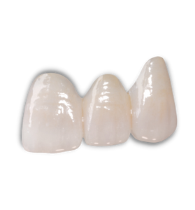 e.Max Crowns, Inlays, and Onlays