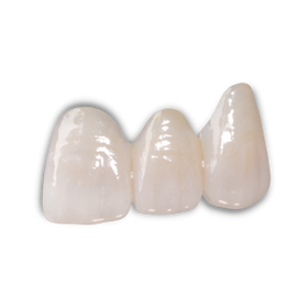 e.Max Crowns, Inlays, and Onlays